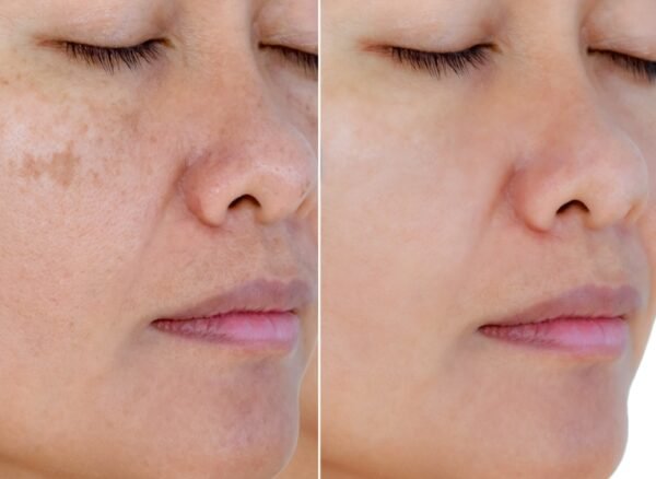 Image,Before,And,After,Spot,Melasma,Pigmentation,Facial,Treatment,On