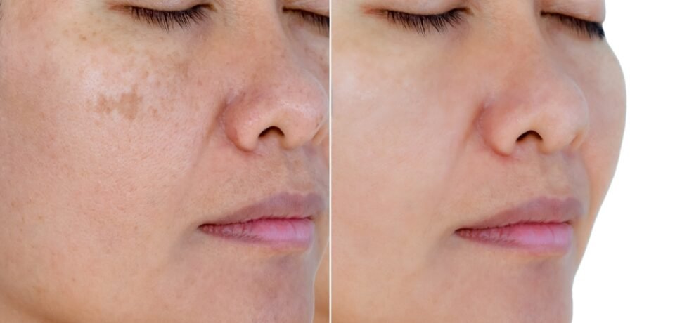 Image,Before,And,After,Spot,Melasma,Pigmentation,Facial,Treatment,On