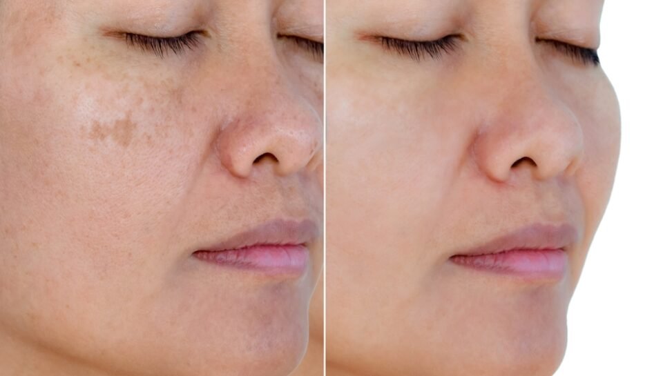 Image,Before,And,After,Spot,Melasma,Pigmentation,Facial,Treatment,On